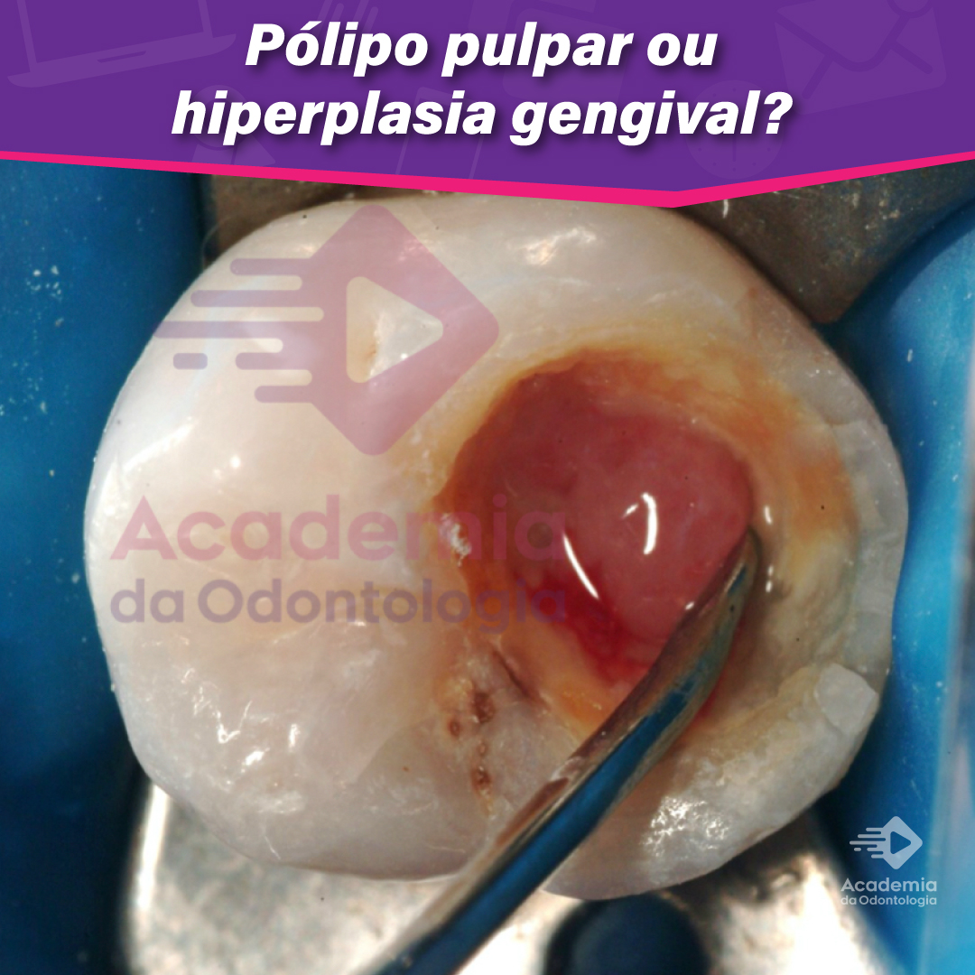 Pólipo pulpar ou hiperplasia gengival Academia da Odontologia