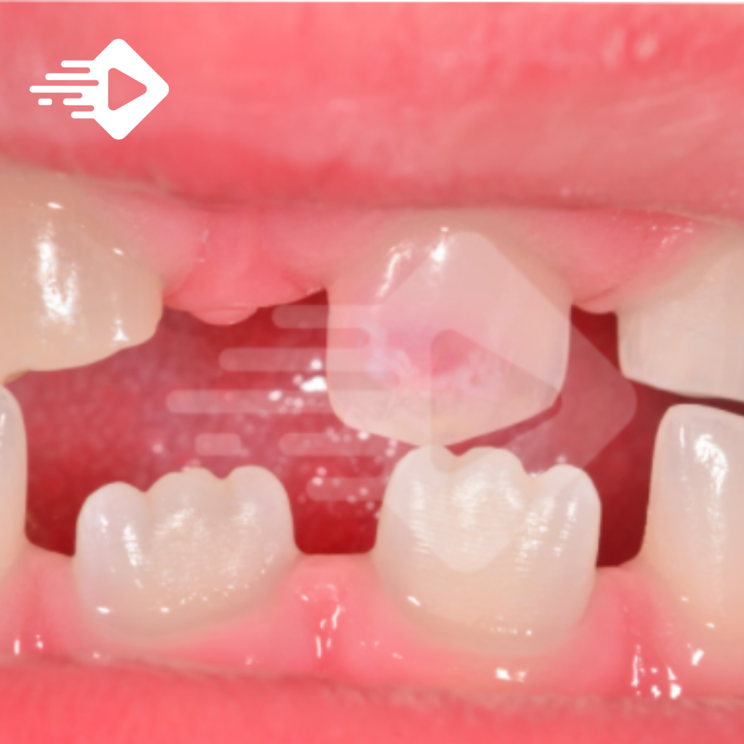 Impacto - Cor e Forma Interna de Dentes Anteriores (Edição