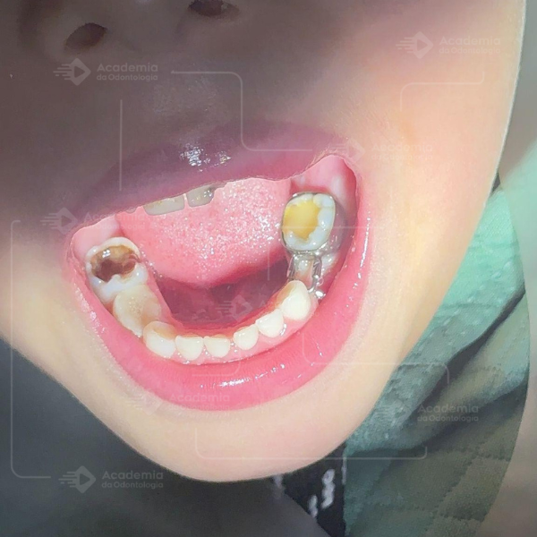Mantenedor de Espaço em Dentes Decíduos Posteriores